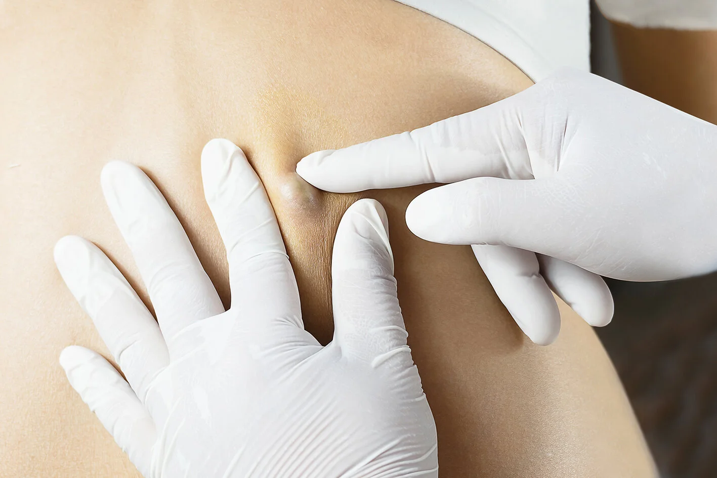 Lipoma Removal in London